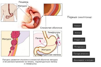 Симптомы и признаки рака желудка на ранней стадии у женщин thumbnail