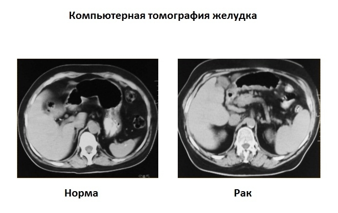 На кт виден рак. Кт органов брюшной полости опухоль желудка. Компьютерная томография желудка.